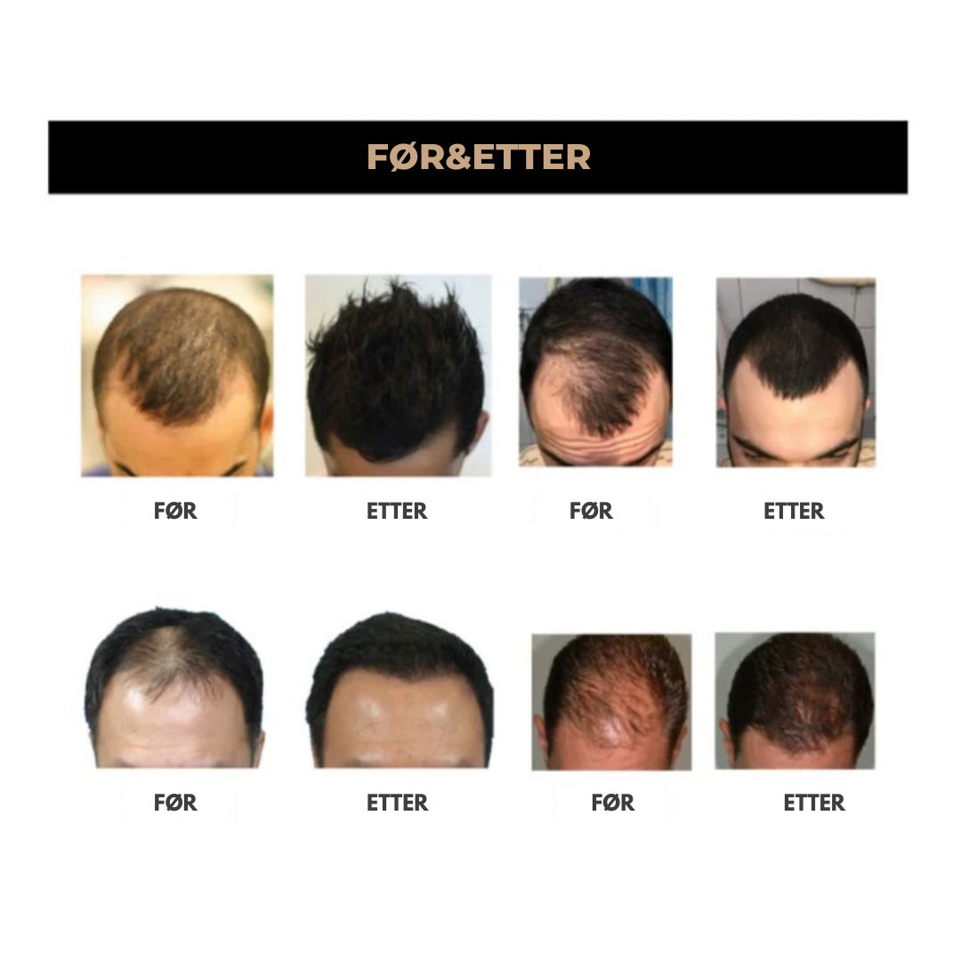 HairFix™ | Ikke flere skallede flekker!